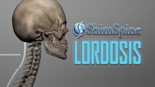 Lordosis [upl. by Bald]