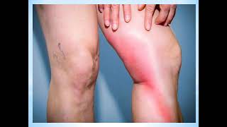 What is Phlebitis and How is it Treated [upl. by Stricklan]