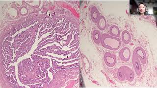 Tip100Swyer Syndrome with Gonadoblastoma and Dysgerminoma [upl. by Hnahk676]