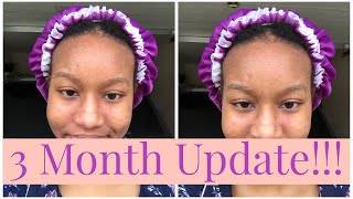 3 Month Metronidazole Cream for Perioral Dermatitis Update  Before and After Photos Included [upl. by Aisatsanna]