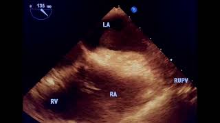 Lung tumor invading left atrium to drahmadmirdamadisiF2BFosOT1z42MaKL [upl. by Alleynad]