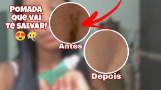 POMADA PARA ESPINHAS ACNE QUE SALVA EM POUCOS DIAS 😍 [upl. by Jewell]