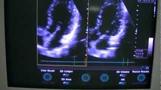 Measurements in 2D mode Ultrasound GE Vivid 3 Part 7 [upl. by Litman613]