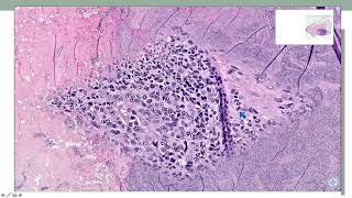 Surgical Pathology Update Diagnostic Pearls for the Practicing Pathologist  CME Teaching Activity [upl. by Ahsaeyt]