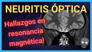 NEURITIS ÓPTICA resonancia magnética 👀 [upl. by Tehr]