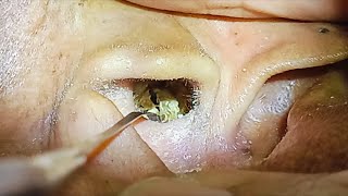 Lỗ Tai Nhiều Mảnh Ráy To  Ears with Many Large Pieces of Wax  Hoai Le earwax [upl. by Hollerman]