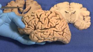 Limbic Neuroanatomy Video Lab  Brain Dissections [upl. by Jarrad183]