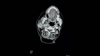 Carcinoma of right lobe of thyroid with metastases How to report [upl. by Dmitri70]