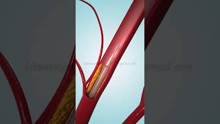 Coronary Angioplasty and Stent Insertion [upl. by Arturo901]