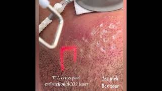 Acne scars TCA cross and FractionalCO2 laser acnescartreatment tcacross fractionalco2laser [upl. by Somerset31]