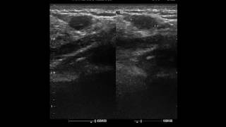 CASE 281 SONOMAMMOGRAPHY FIBROADENOSIS [upl. by Aerbas]