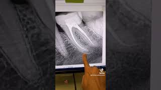 Root canal retreatment of tooth 19 [upl. by Eyahs]