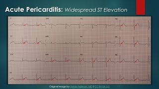 Acute Pericarditis ECG [upl. by Milburn]