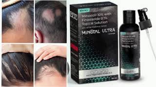 MINOTAL ULTRA Topical Solution Minoxidil 10 with Finasteride 01 Topical Solution [upl. by Amla]