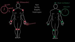 Osteoartrit ve Romatoid Artrit Semptomları Fen Bilimleri Sağlık ve Tıp [upl. by Labanna]