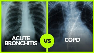 Understanding the Differences Acute Bronchitis vs COPD  Medical Insights [upl. by Tem546]