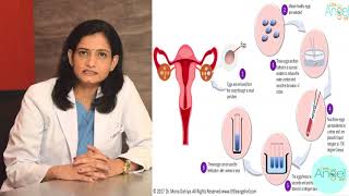 What is a Egg freezing  Type and Procedure of Egg freezing  Dr Mona Dahiya [upl. by Fleck]