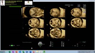 FETAL HIDROPS  MULTICYSTIC HYGROMA  TRISOMI 21 Down Syndrome Dr Wiku Andonotopo [upl. by Lustig]