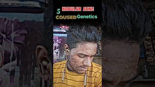 NODULAR ACNE song shortsyoutube viraldisease viralshort [upl. by Anirehtak]