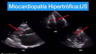 Miocardiopatía Hipertrófica Fácil 1 mecanismo [upl. by Alket]