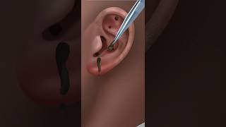 ASMR ear treatment remove earwax amp blackhead ear stone removal treatment 2d animation hkkingasmr [upl. by Narba]