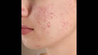 acne old age blackhead elder new 2024  sac be spa acne skincare routine full details [upl. by Eizzil189]