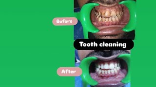 Live Tooth Cleaning Scaling Procedure At dentocare multispeciality dental clinic [upl. by Lorry]