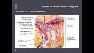 How to Get Rid of Senile lentigines  Senile lentigines Treatment [upl. by Grae]