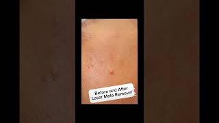 Laser mole removal lasermole moleremoval [upl. by Conroy113]