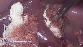 Laparoscopic cholecystectomy unedited 882024 [upl. by Petronia]