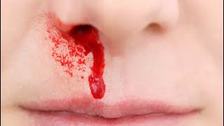 Epistaxis causes  Causes of Epistaxis Mnemonic  Management of Epistaxis [upl. by Yuh]