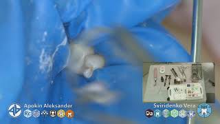 Caries classII 35 EvoCeram Syntac Polydentia Sanctuary TorVM FHD multistream [upl. by Retse443]