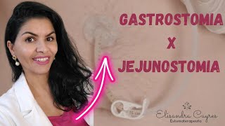 GASTROSTOMIA E JEJUNOSTOMIA VOCÊ SABE QUAL É A DIFERENÇA [upl. by Emmerie]