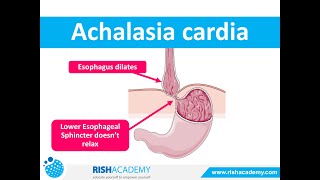 Achalasia Cardia  Definition Etiology Pathophysiology Clinical features Diagnosis amp Treatment [upl. by Huxley]