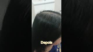 Alopecia Androgenética Antes e DepoisVejam Esse Antes e Depois Surpreendente LINK ABAIXO shorts [upl. by Slemmer]