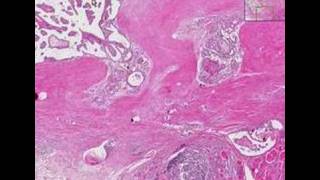 Histopathology ThyroidHashimoto thyroiditis papillary car [upl. by Dave207]