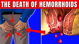 How to GET RID OF Hemorrhoids FOREVER Hemorrhoids Treatment [upl. by Stockwell]