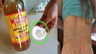 tinea versicolor treatment  how to get rid of tinea versicolor natural treatment [upl. by Gomer454]