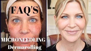 Microneedling  Dermarolling QampA  Before During and After Pics [upl. by Ettenot]