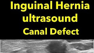 Inguinal Hernia ultrasound  learn how to diagnose easy [upl. by Inavoig]