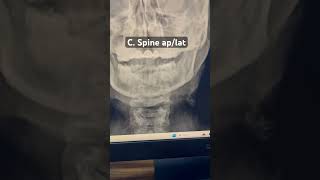 Xray c spine ap\lat xray spine ctscan radiology radiography radiologytechnologist doctor [upl. by Inverson464]