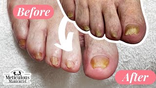 Pedicure Beauty Series Rams Horn Toenail Transformation [upl. by Barbee]