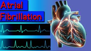 Atrial fibrillation symptoms causes risks and treatment [upl. by Eanahc]