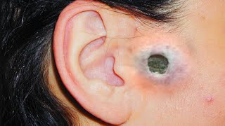 Ear and Nose Blackheads Biggest and Most Popular Comedone Extractions [upl. by Nassi]