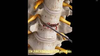 Anterior Cervical Discectomy and FusionACDF [upl. by Nerra]