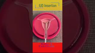 IUD insertion [upl. by Mahseh428]