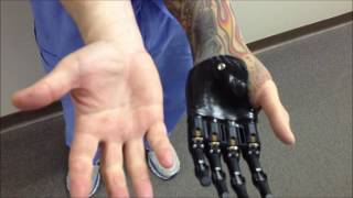 Idigits from Touch Bionics [upl. by Soll]