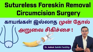 Sutureless Foreskin Removal Circumcision Surgery காயங்கள் இல்லாத முன் தோல் அறுவை சிகிச்சைDr Ashok [upl. by Sculley]