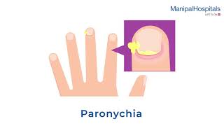 What is Paronychia and Its Treatment  Manipal Hospitals India [upl. by Aniehs]