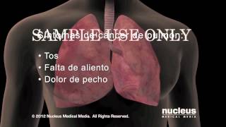 Síntomas del cáncer de pulmón [upl. by Giacamo542]